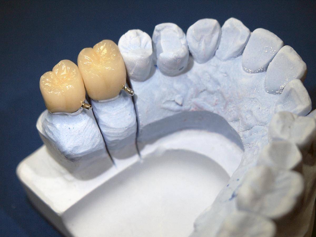 セラミックと金属どっちが正解？見た目と強度で選ぶ治療素材の最適解