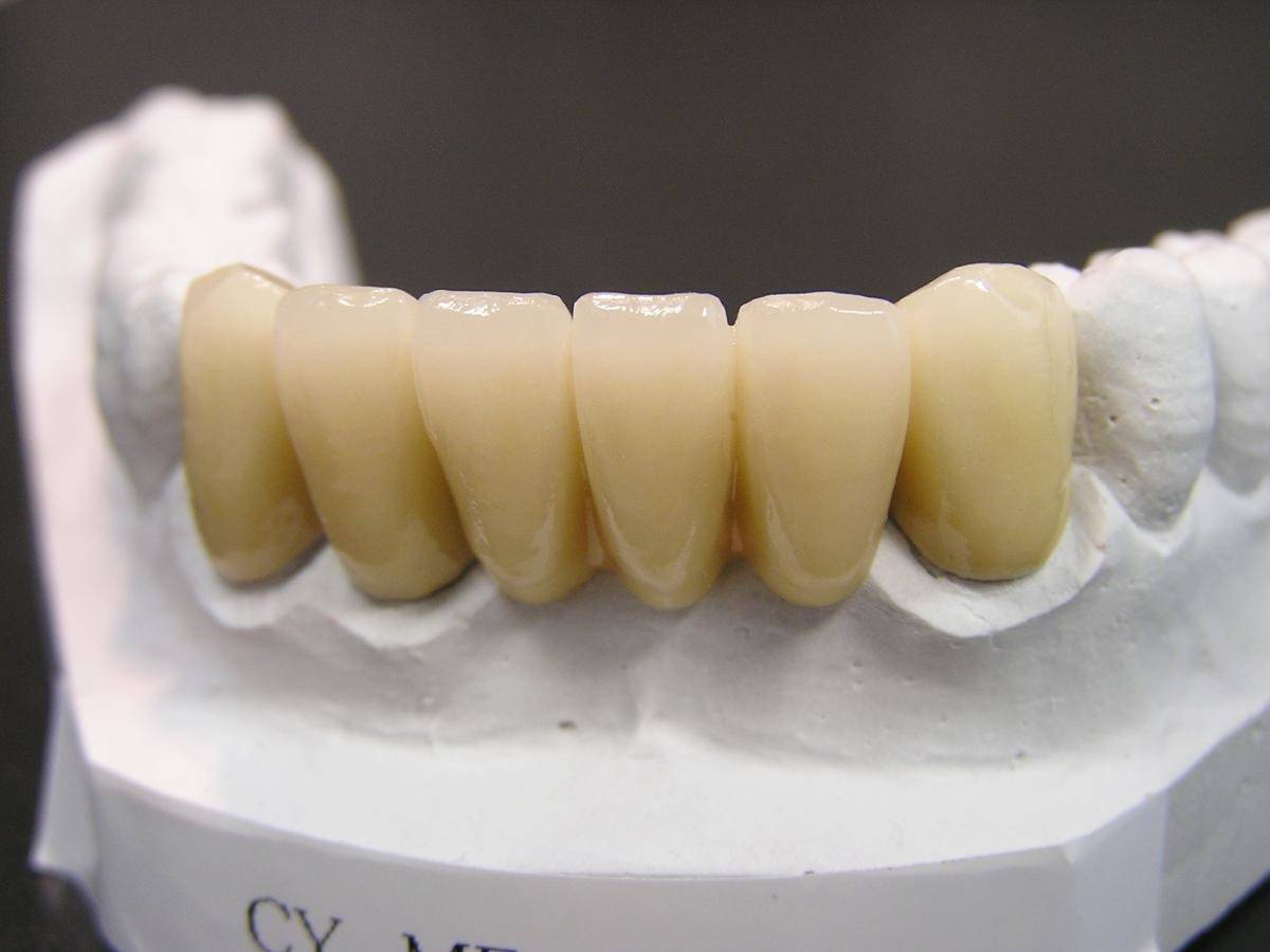 セラミック治療後の連結部に効く！フロス清掃の正しい方法とは
